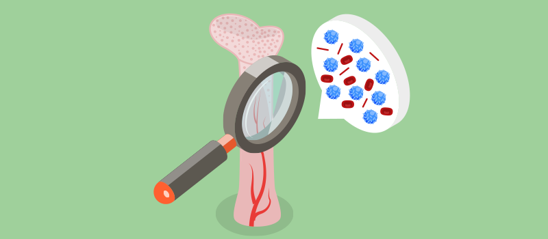 Myelofibrosis