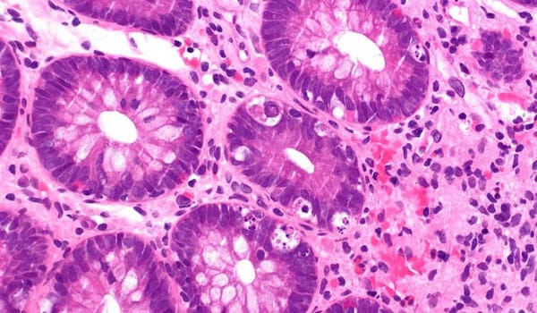 Chronic Graft-Versus-Host Disease (cGVHD)